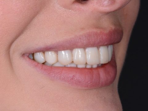 Виниры E-max — фото системы